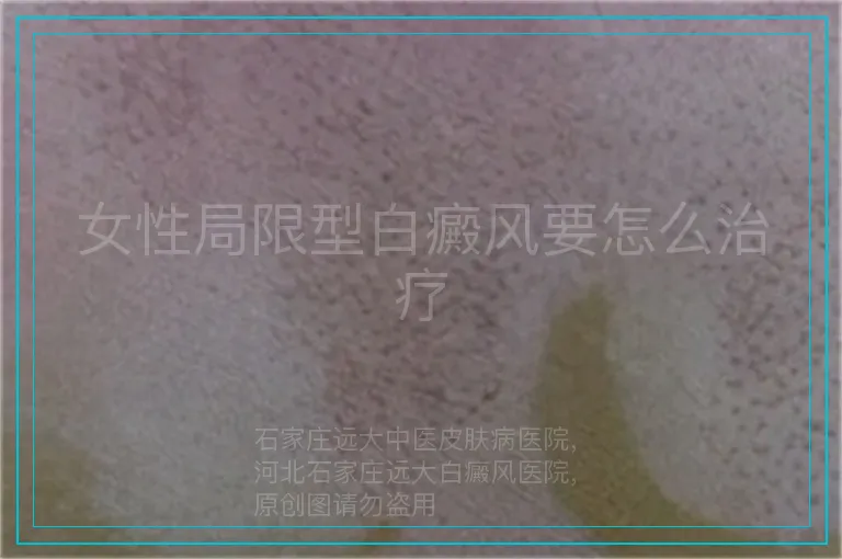 女性局限型白癜风要怎么治疗