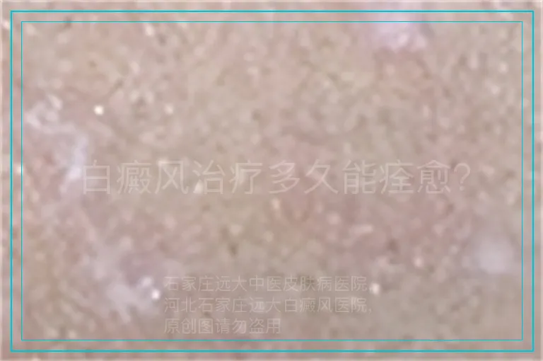 白癜风治疗多久能痊愈？