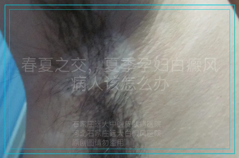 春夏之交，夏季孕妇白癜风病人该怎么办