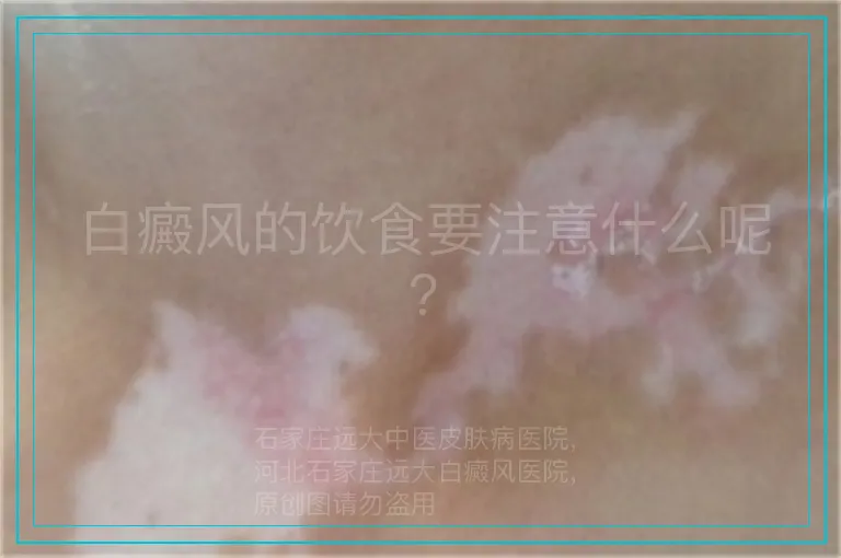 白癜风的饮食要注意什么呢?