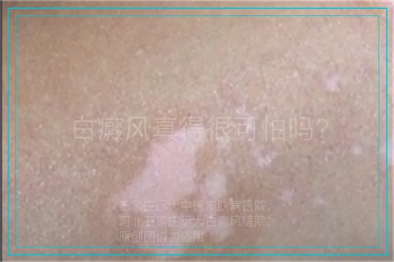 白癜风真得很可怕吗?
