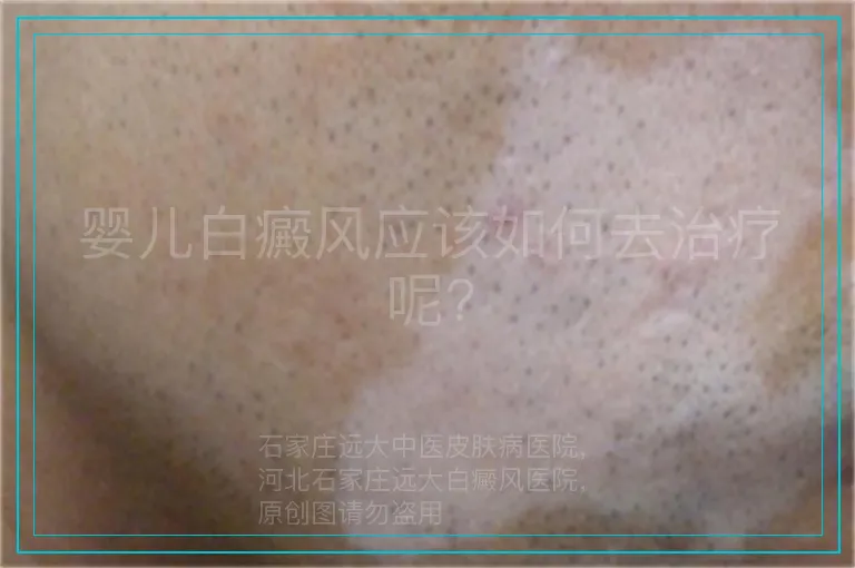 婴儿白癜风应该如何去治疗呢?