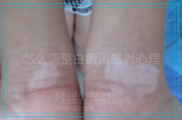 怎么调整白癜风患者心理