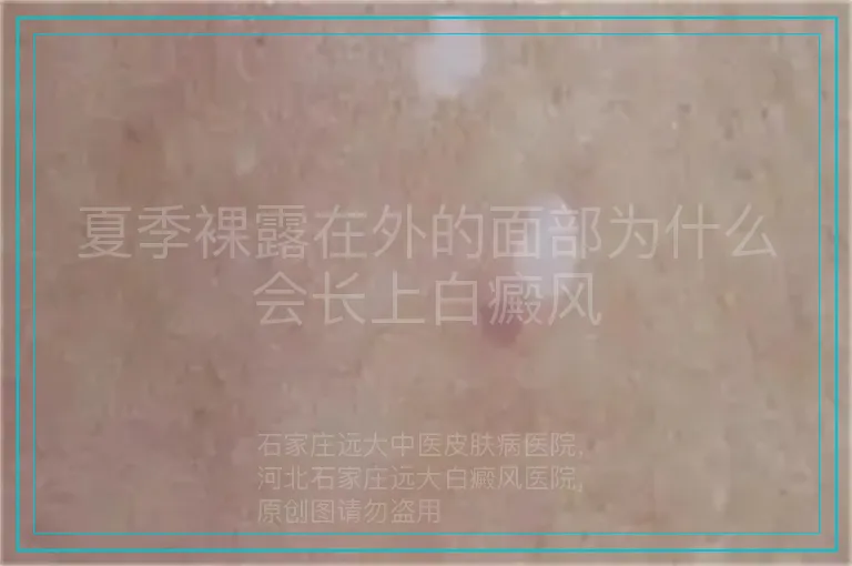 夏季裸露在外的面部为什么会长上白癜风