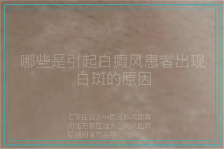 哪些是引起白癜风患者出现白斑的原因