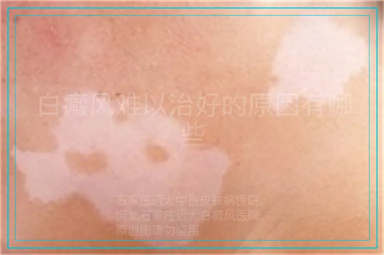 白癜风难以治好的原因有哪些