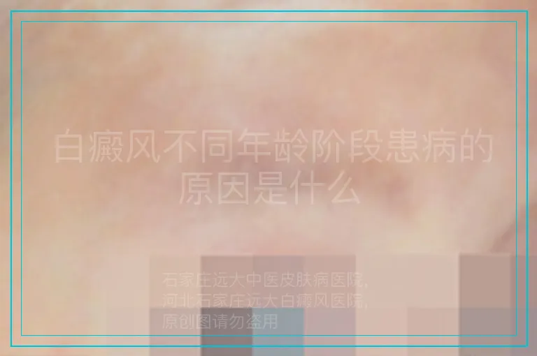 白癜风不同年龄阶段患病的原因是什么