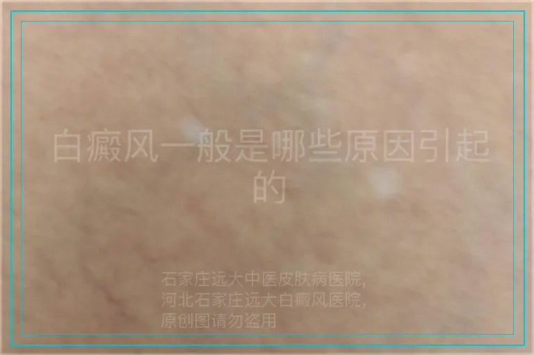 白癜风一般是哪些原因引起的