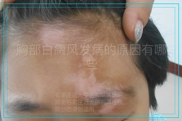 胸部白癜风发病的原因有哪些