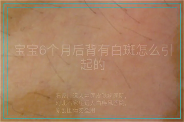 宝宝6个月后背有白斑怎么引起的