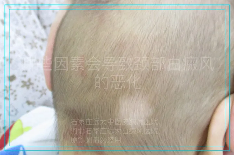 哪些因素会导致颈部白癜风的恶化