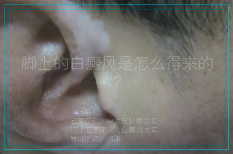 脚上的白癜风是怎么得来的?