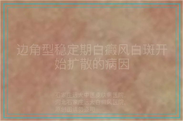 边角型稳定期白癜风白斑开始扩散的病因