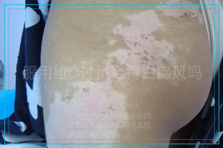 服用维C过量会得白癜风吗