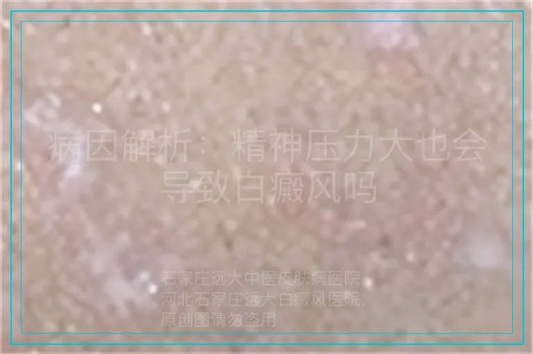 病因解析：精神压力大也会导致白癜风吗
