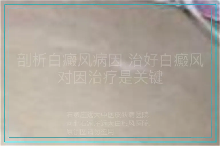 剖析白癜风病因 治好白癜风对因治疗是关键