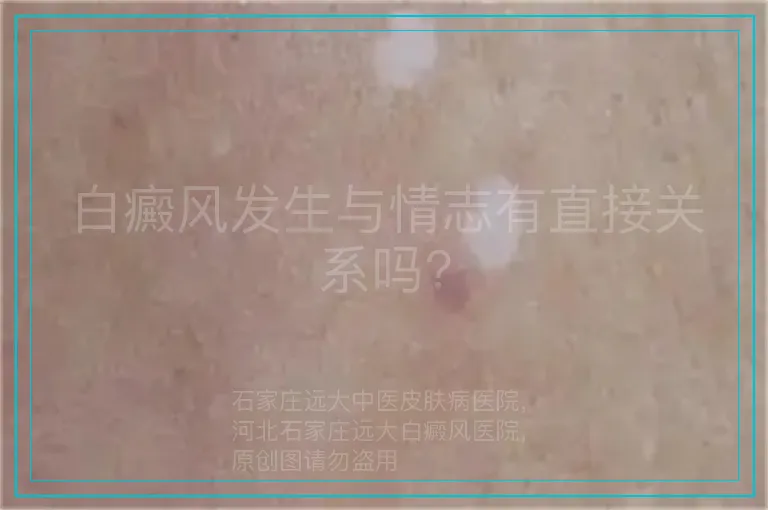 白癜风发生与情志有直接关系吗?