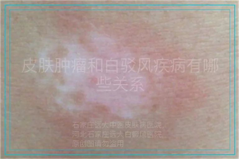 皮肤肿瘤和白驳风疾病有哪些关系