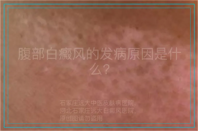 腹部白癜风的发病原因是什么?