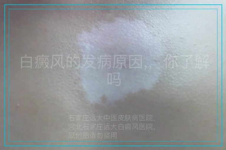 白癜风的发病原因,，你了解吗