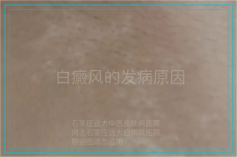 白癜风的发病原因