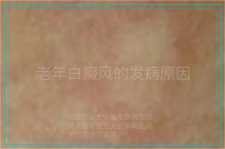 老年白癜风的发病原因
