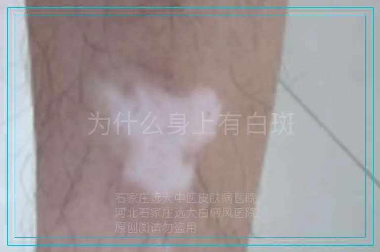 为什么身上有白斑