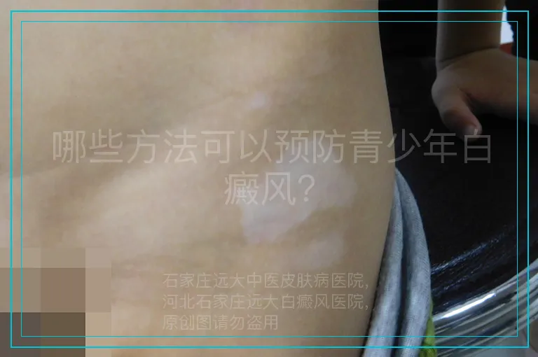 哪些方法可以预防青少年白癜风？