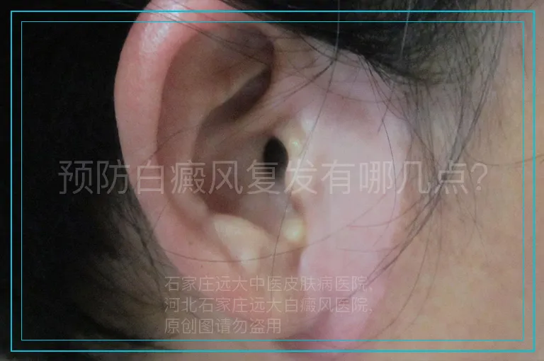 预防白癜风复发有哪几点?