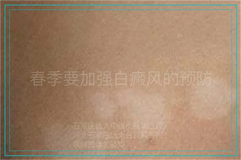 春季要加强白癜风的预防