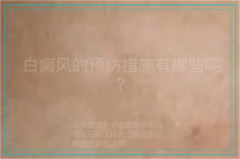 白癜风的预防措施有哪些呢?