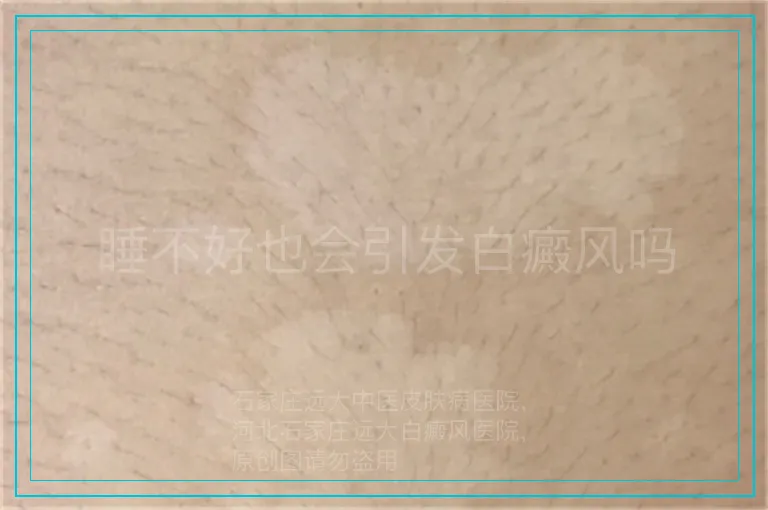 睡不好也会引发白癜风吗