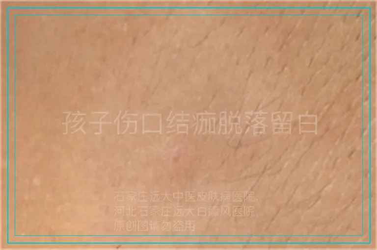 孩子伤口结痂脱落留白