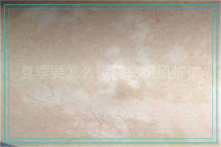 夏季要怎么预防白癜风扩散