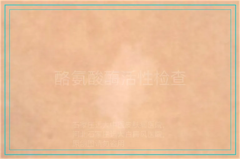 酪氨酸酶活性检查