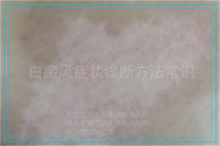白癜风症状诊断方法常识