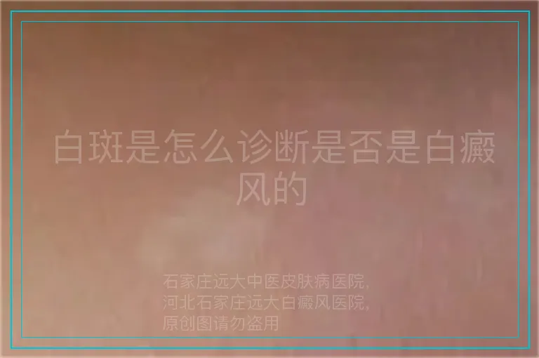 白斑是怎么诊断是否是白癜风的