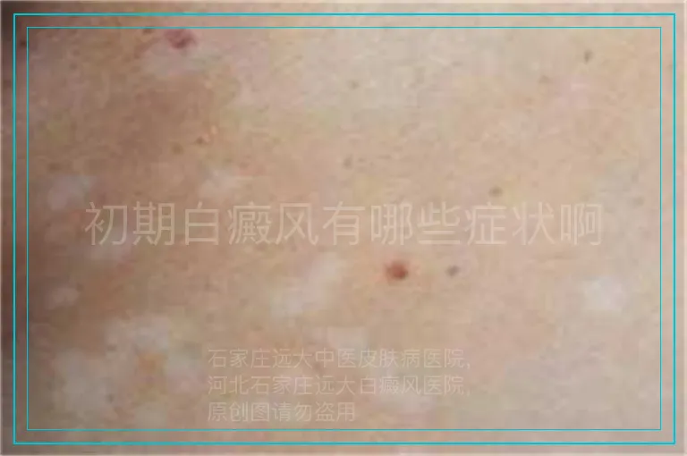初期白癜风有哪些症状啊