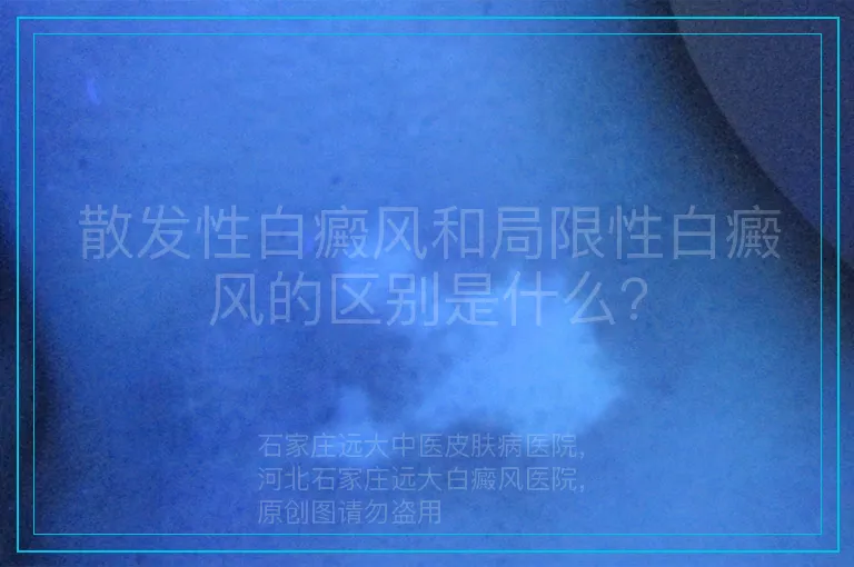 散发性白癜风和局限性白癜风的区别是什么？