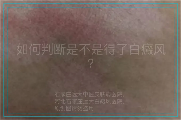 如何判断是不是得了白癜风？