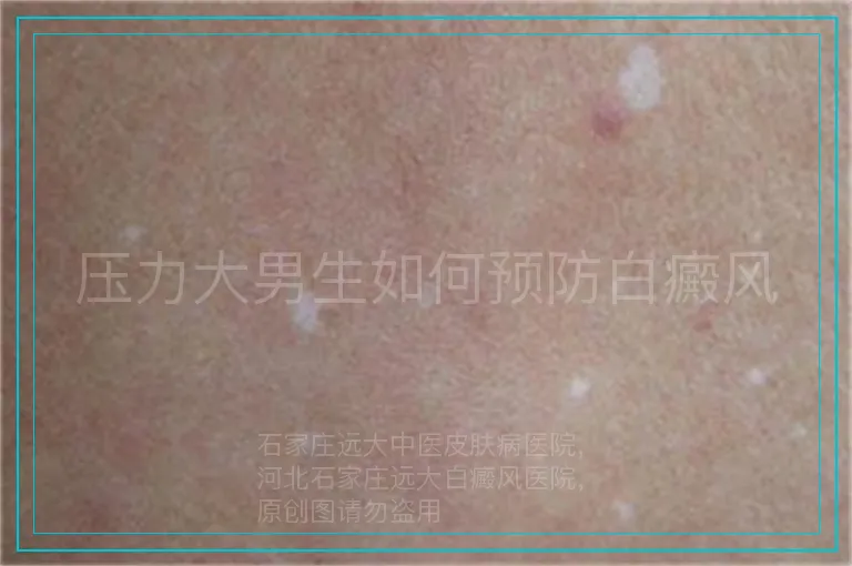 压力大男生如何预防白癜风