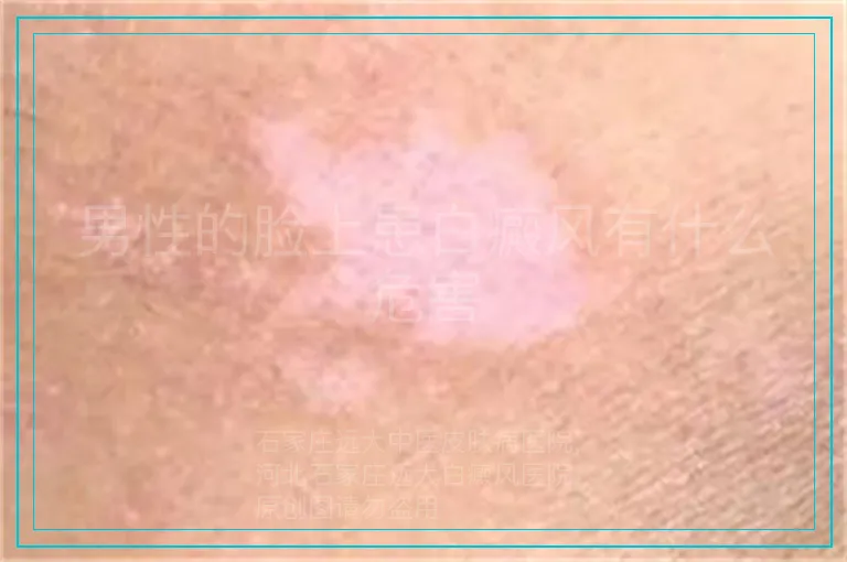 男性的脸上患白癜风有什么危害