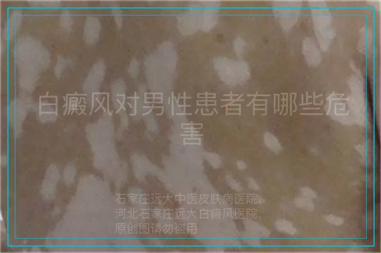 白癜风对男性患者有哪些危害