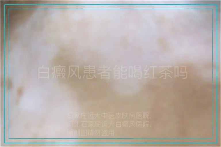 白癜风患者能喝红茶吗