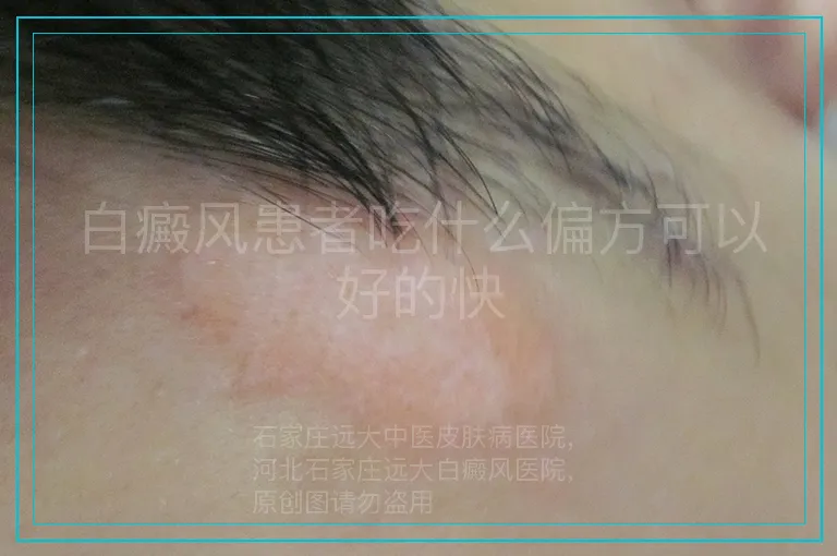 白癜风患者吃什么偏方可以好的快