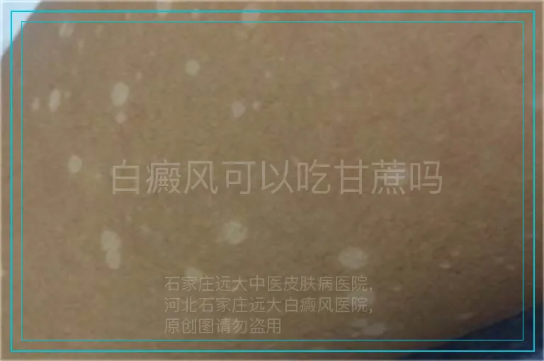 白癜风可以吃甘蔗吗