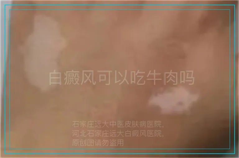 白癜风可以吃牛肉吗