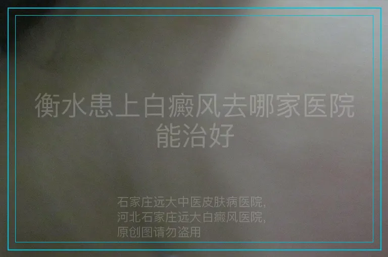 衡水患上白癜风去哪家医院能治好