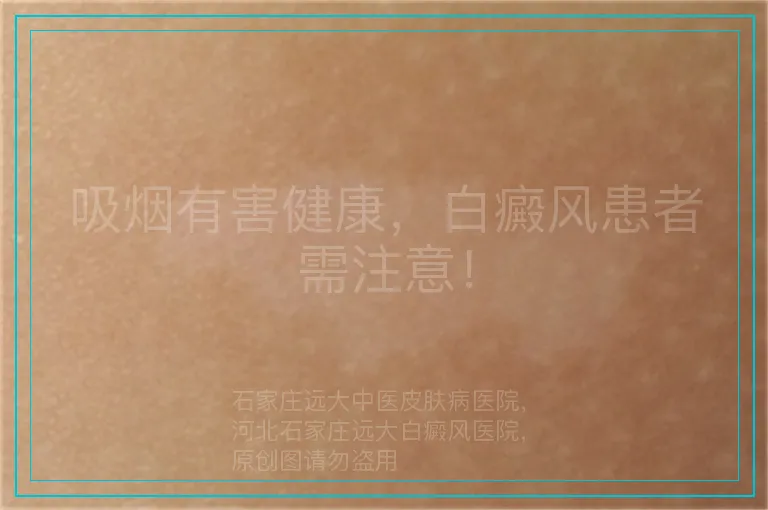 吸烟有害健康，白癜风患者需注意！