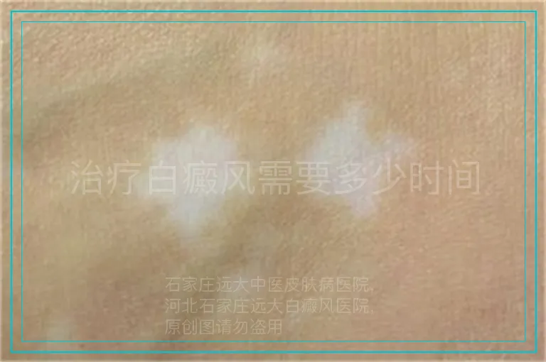 治疗白癜风需要多少时间